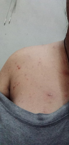 อีสุกอีใสตอนท้อง