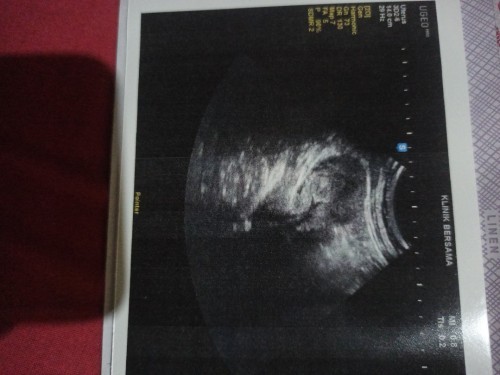 Hasil usg belum kelihatan