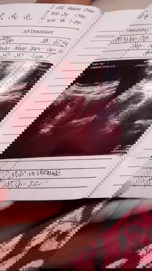 6 Minggu belum terlihat janin