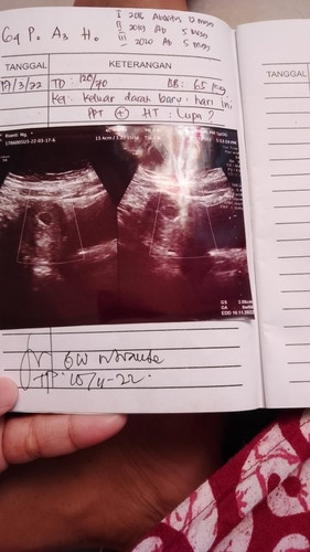 6 Minggu belum terlihat janin