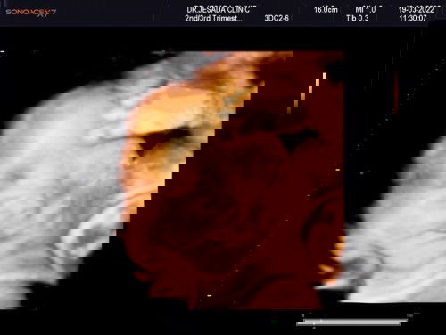 อัลตราซาวด์ 4 มิติ
