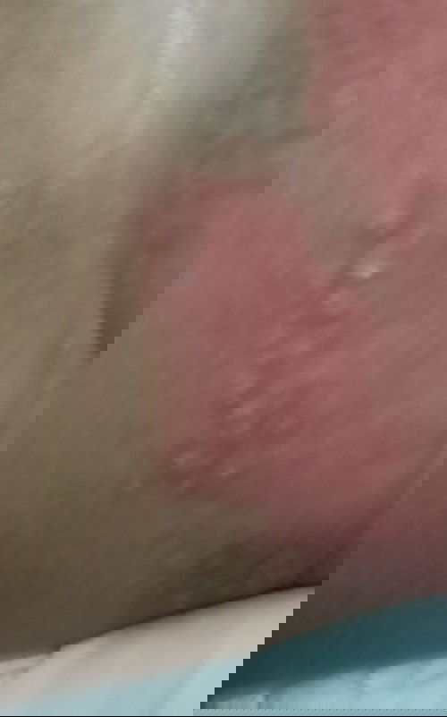 Sya mau tanya ..
Bayi saya umur 11 bulan mengalami seperti ruam d paha . Itu knpa ya 🥺