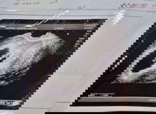 ตั้งครรภ์ 8 สัปดาห์ ไม่มีอาการแพ้ท้อง