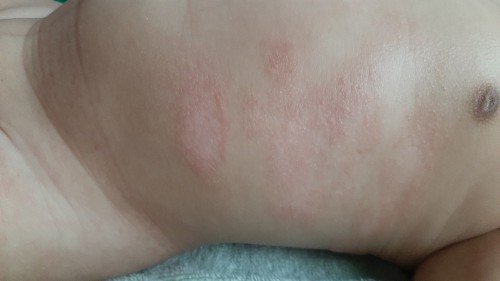 Anakku alergi antiseptic, antibacterial & minyak telon