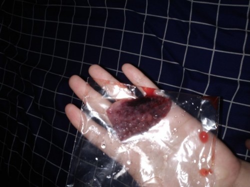 Hamil 9 minggu keluar darah flek dan jaringan