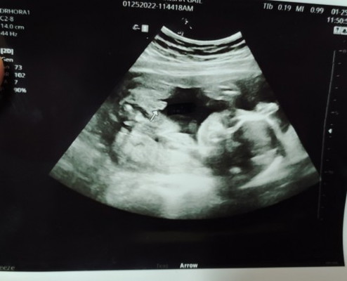 Baby gender