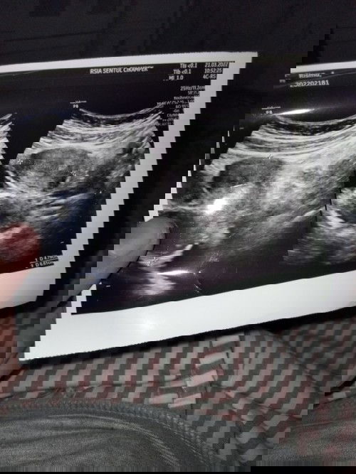 Hamil 5 week, saat USG masih kosong