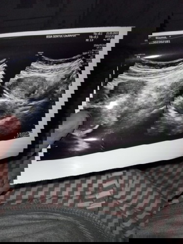 Hamil 5 week, saat USG masih kosong