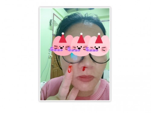 ตั้งครรภ์ 33+3W เลือดกำเดาไหล