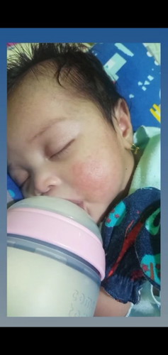 Ruam pada pipi bayi 6 bulan