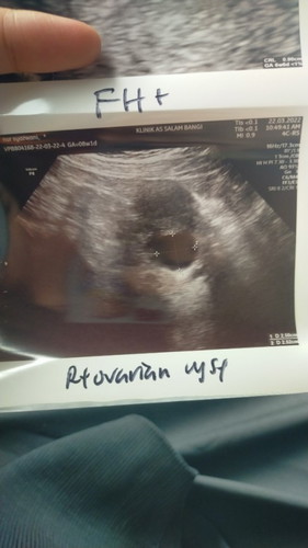 Size baby dan cyst