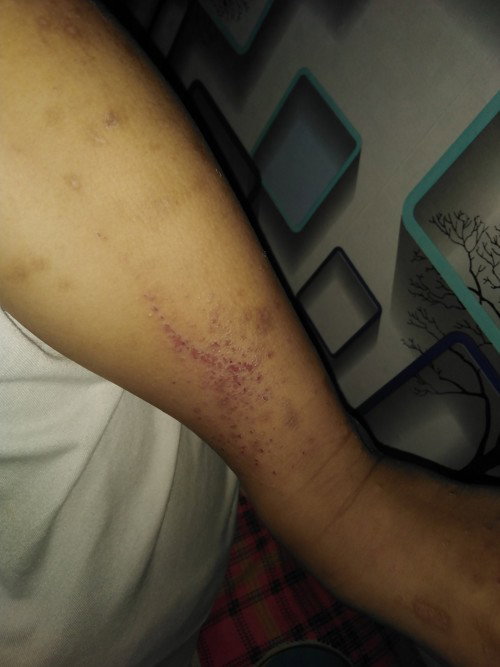 Skin rashes