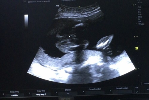22weeks boy ker girl ?