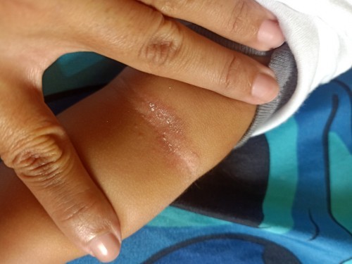 Kemerahan pada bayi