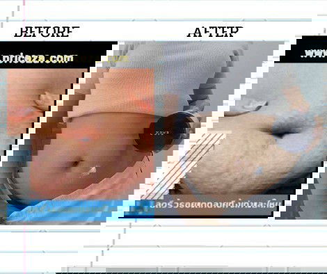 มาแบ่งปันวิธีดูแลผิวหน้าท้องหลังคลอดค่ะ