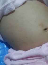 Kemerahan pada kulit bayi 3 bulan