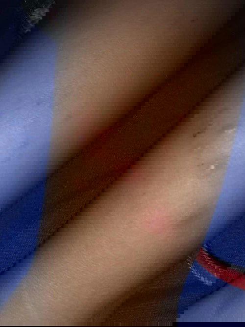 Bentol dan ruam merah