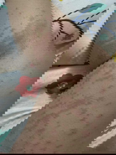 แม่บ้านไหนผื่นขึ้นตอนท้องมั้ยคะ