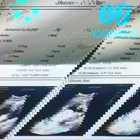 ซาวด์คราว อัลตราซาวด์ 4 เดือน