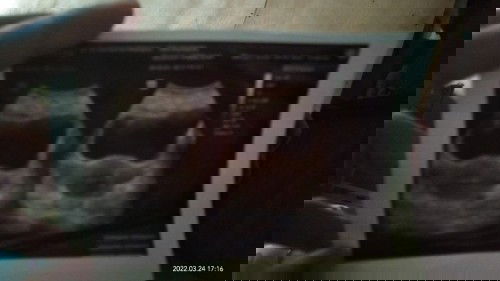 Postif tetapi katax tidak ada pembesaran rahim,pokokx belum ada apa"