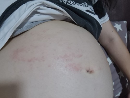 Tummy very itchy -Pregnant W28