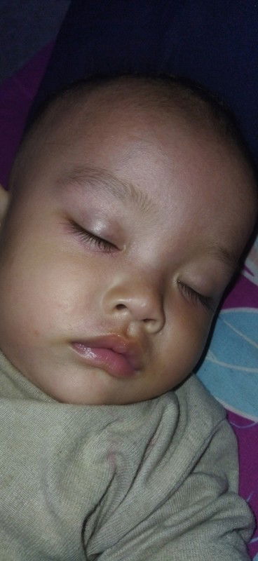 Biang keringat apa alérgi