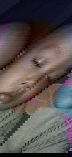 Biang keringat apa alérgi