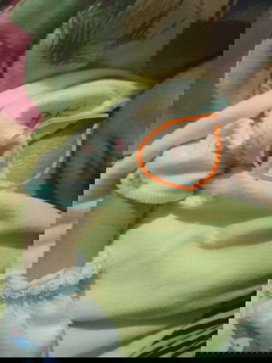 Bintik merah kulit mengelupas