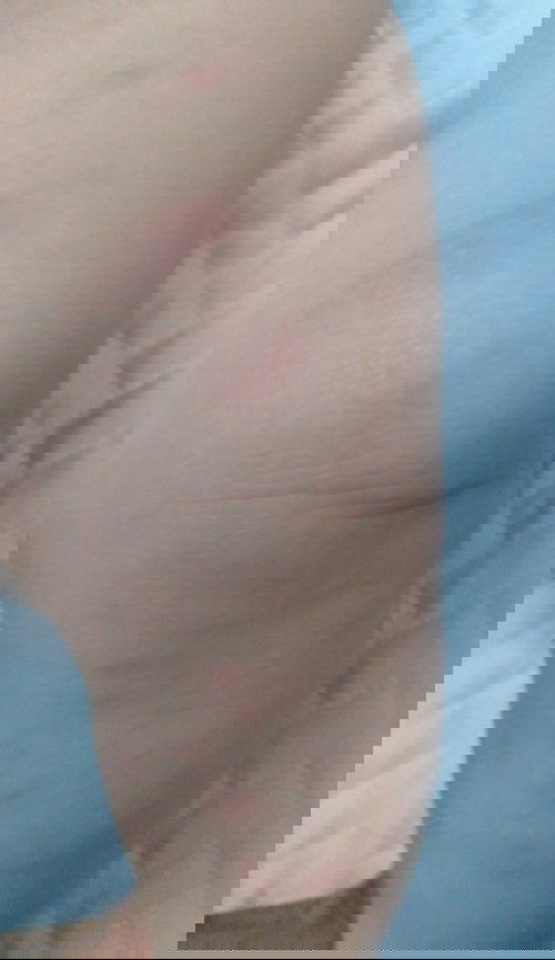 Bé Bị mẩn đỏ