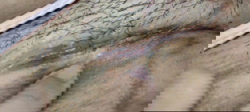 Luka operasi SC sudah kering, berlubang lagi