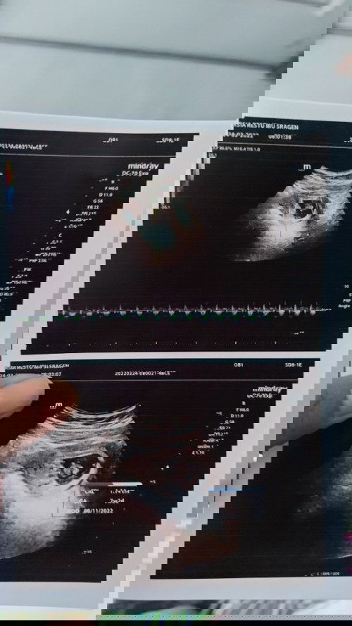 Setelah pendarahan mual muntah berkurang dan nafsu makan mulai kembali sedikit"