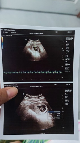 Setelah pendarahan mual muntah berkurang dan nafsu makan mulai kembali sedikit"