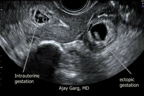 Mengandung Luar Rahim?