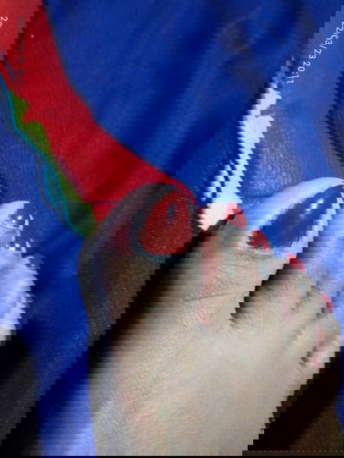 Anung gamot or ointment pwede sa ingrown