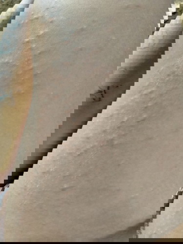 คุณแม่บ้านไหนเป็นผื่นตอนตั้งครรภ์บ้างค้ะมันเป็นอันตรายต่อเด็กไหมค้ะเป็นตรงท้องรามมาขาแล้วจ้ะ