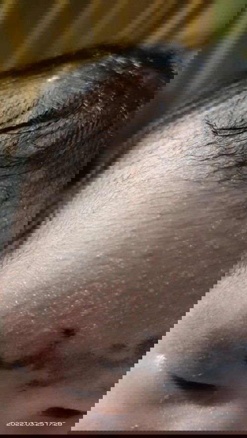 Merentis dan Bintik di kepala bayi baru lahir