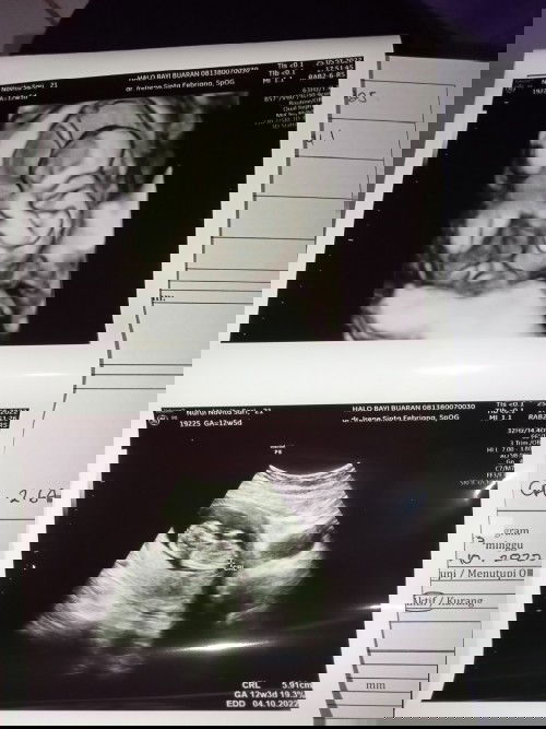 Pertama kali usg❤️
