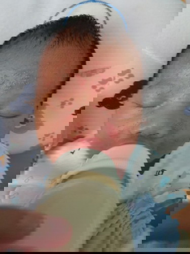 ผื่นขึ้นหน้า