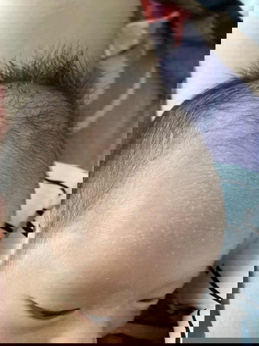 ตุ่มใสๆที่หน้าผาก?