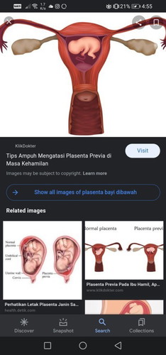 Low Lying placenta