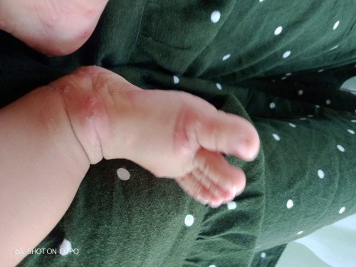Gatal2 pada bayi