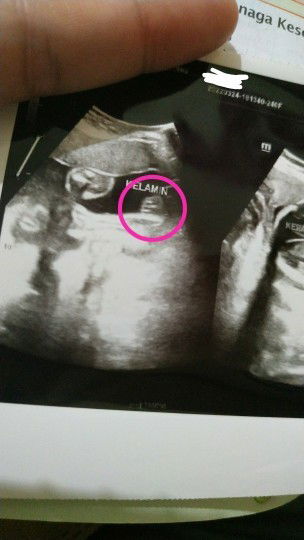 Hasil USG cewek/cowok