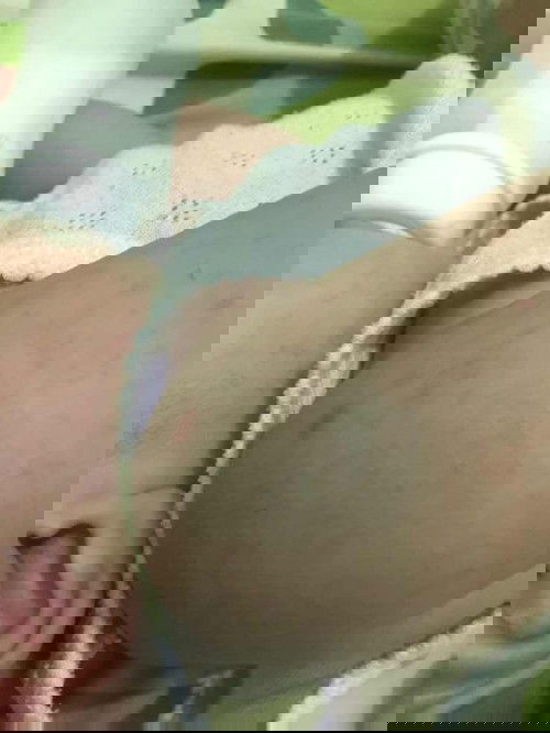 Alergi atau biang kringet ya