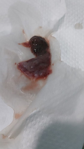 6 weeks and 1 day bleeding