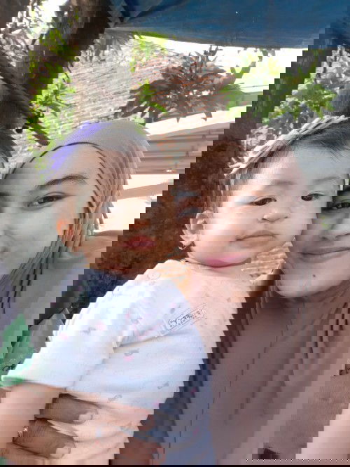 BERCAK PUTIH DI SEKITAR MATA BAYI