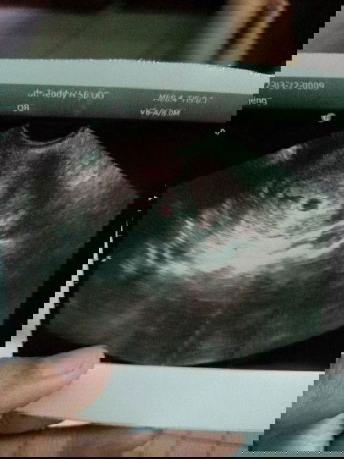 Usia kehamilan bidan dan USG donter tidak sama?