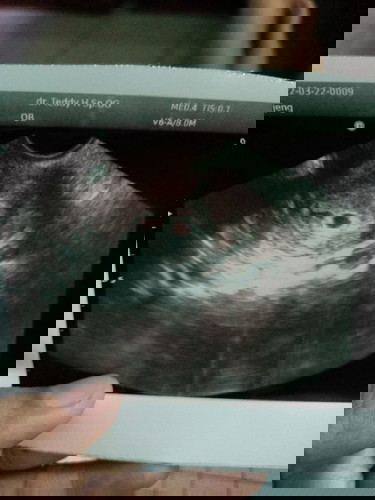 Usia kehamilan bidan dan USG donter tidak sama?