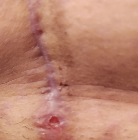 CS with wound