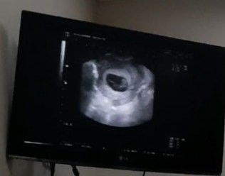 Janin tidak ada detaknya