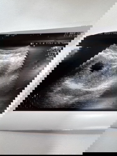 พบถุงตั้งครรภ์ แต่ไม่พบตัวอ่อน